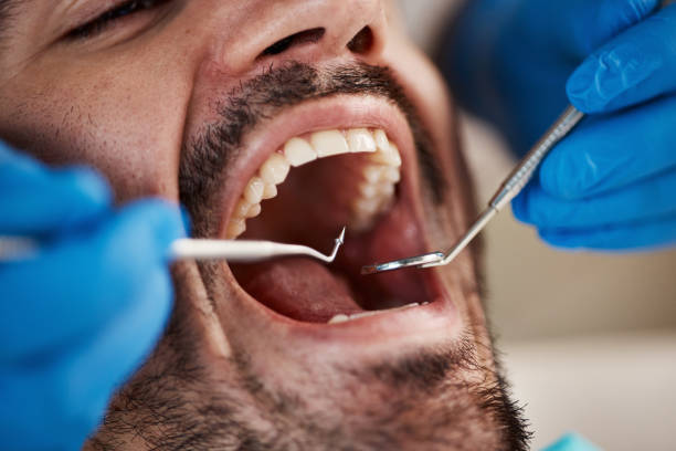 Best Emergency Treatment for Dental Infections or Abscesses in Monument, CO